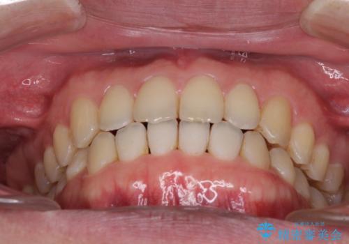 すきっ歯の改善　インビザライン矯正治療の治療後