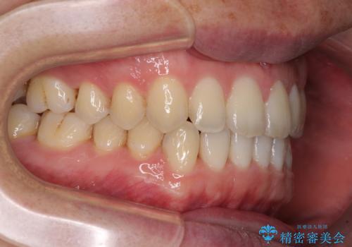 すきっ歯の改善　インビザライン矯正治療の治療後
