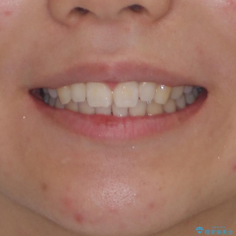 前歯のデコボコを治したい　インビザラインによる矯正治療の治療後（顔貌）