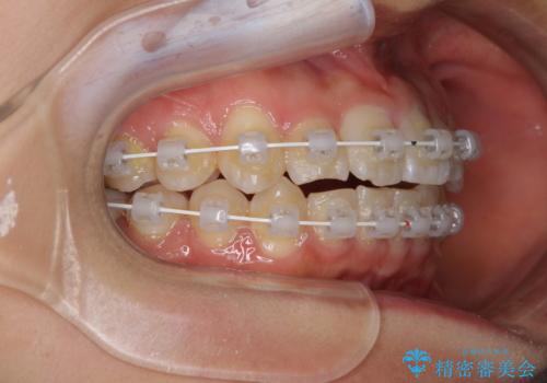 短期間で治療したい　目立たないワイヤー装置での非抜歯矯正の治療中