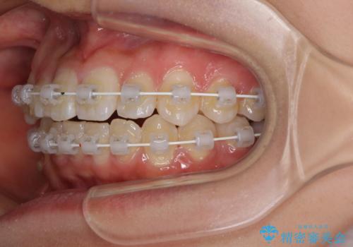 短期間で治療したい　目立たないワイヤー装置での非抜歯矯正の治療中