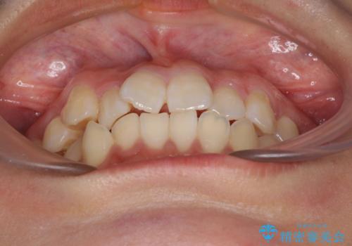 短期間で治療したい　目立たないワイヤー装置での非抜歯矯正の治療前