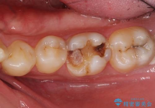 放置した虫歯の治療　親知らずの手前が虫歯の治療前