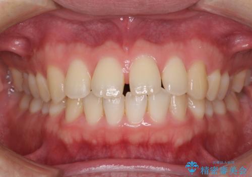 すきっ歯の改善　インビザライン矯正治療の治療前