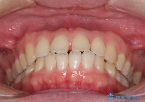 すきっ歯の改善　インビザライン矯正治療の治療前