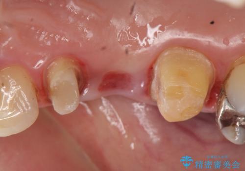オールセラミッククラウン　歯根破折→抜歯→ブリッジの治療中