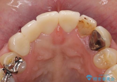 オールセラミッククラウン　下がってしまった前歯の歯茎の改善の治療後