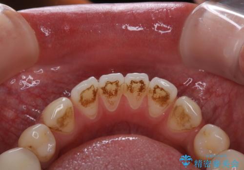 虫歯治療を始める前のPMTCの治療前