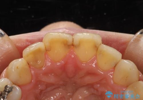 歯と歯の間の着色除去の治療後