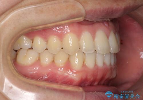 すきっ歯の改善　インビザライン矯正治療の治療中