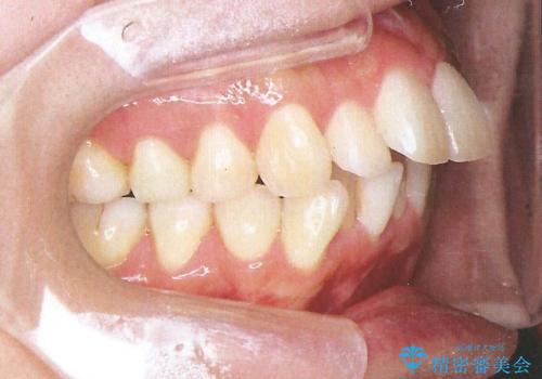 裏側装置で出っ歯の矯正治療の治療前