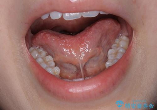 舌小帯の形成の治療前