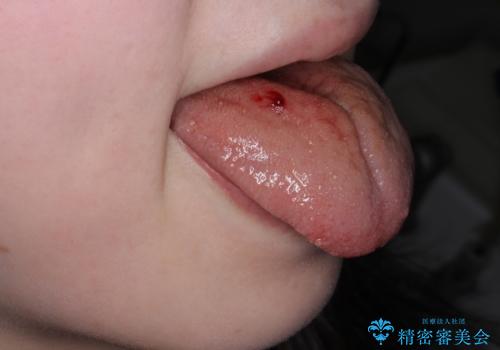 舌小帯の形成の治療中
