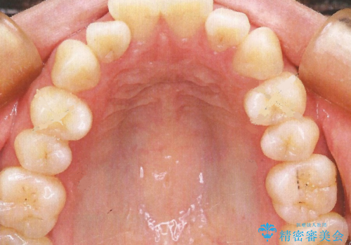 裏側装置で出っ歯の矯正治療の治療前