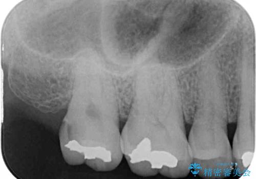 奥歯の虫歯　ゴールドインレーによる修復治療の治療前