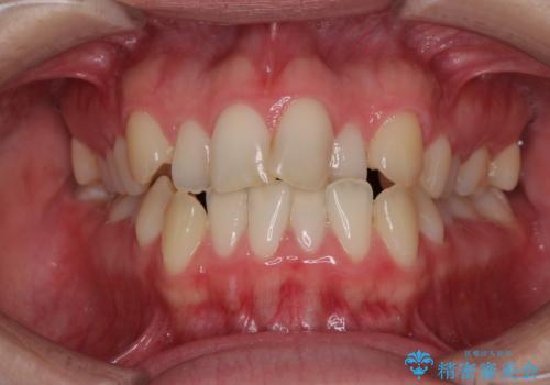 前歯のクロスバイトを治したい　インビザラインによる矯正治療の症例 治療前