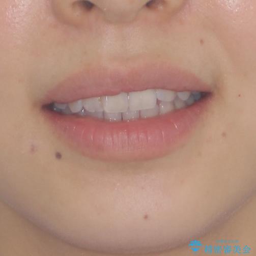 気になる上の歯を改善　インビザライン矯正の治療前（顔貌）