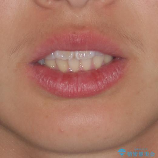 前歯のデコボコを短期間で治療　目立たないワイヤー矯正の治療前（顔貌）