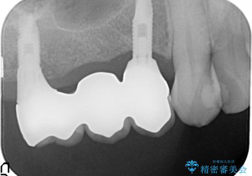 奥歯がなくなり咬めない　インプラント治療による咬み合わせの回復の治療後