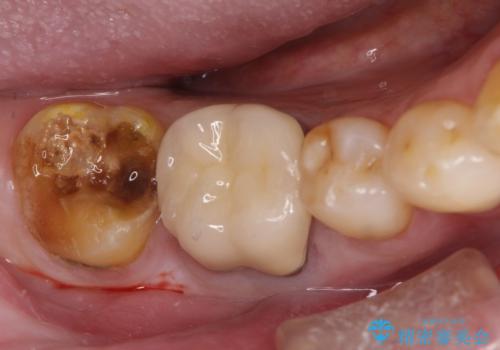 虫歯の治療　ゴールドクラウンの治療前