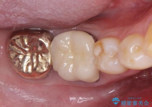 虫歯の治療　ゴールドクラウンの治療後