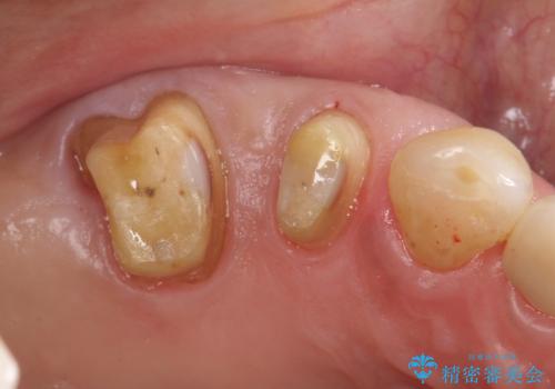 歯周病の進行した歯の抜歯。オールセラミッククラウンの治療中