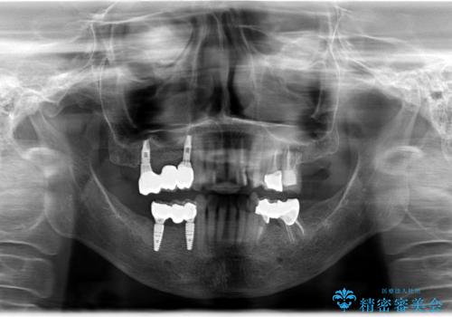 奥歯がなくなり咬めない　インプラント治療による咬み合わせの回復の治療後