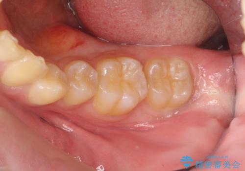 [骨隆起除去手術 ]  舌のスペースを確保するの治療前