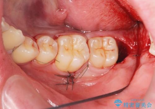 [骨隆起除去手術 ]  舌のスペースを確保するの治療中