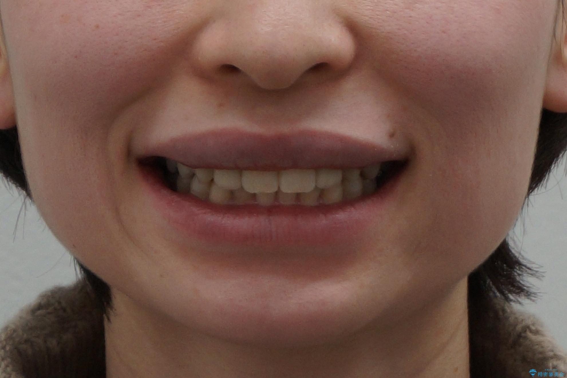 前歯を整えたい　小さい前歯がある　矯正・セラミック併用で美しく　インビザラインでも抜歯矯正できますの治療後（顔貌）
