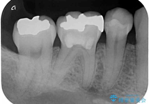 矯正の後戻りの改善と銀歯をセラミックにの治療前