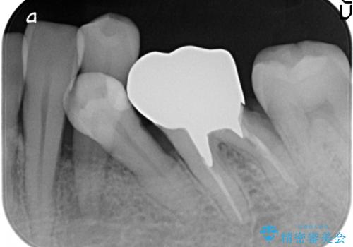 インプラント　左下奥歯の咬み合わせの改善の治療前