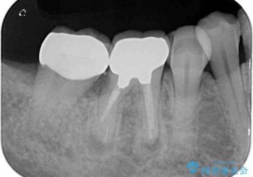 痛みを感じる奥歯　根管治療とインプラント治療の治療後