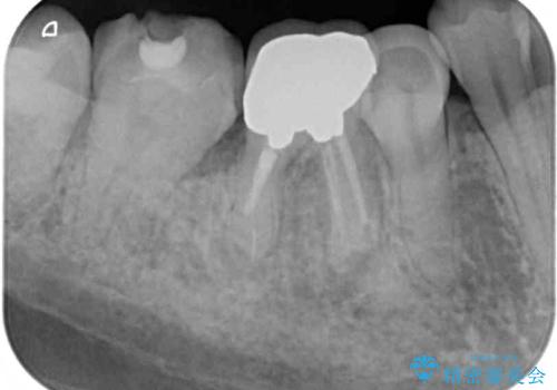 痛みを感じる奥歯　根管治療とインプラント治療の治療前