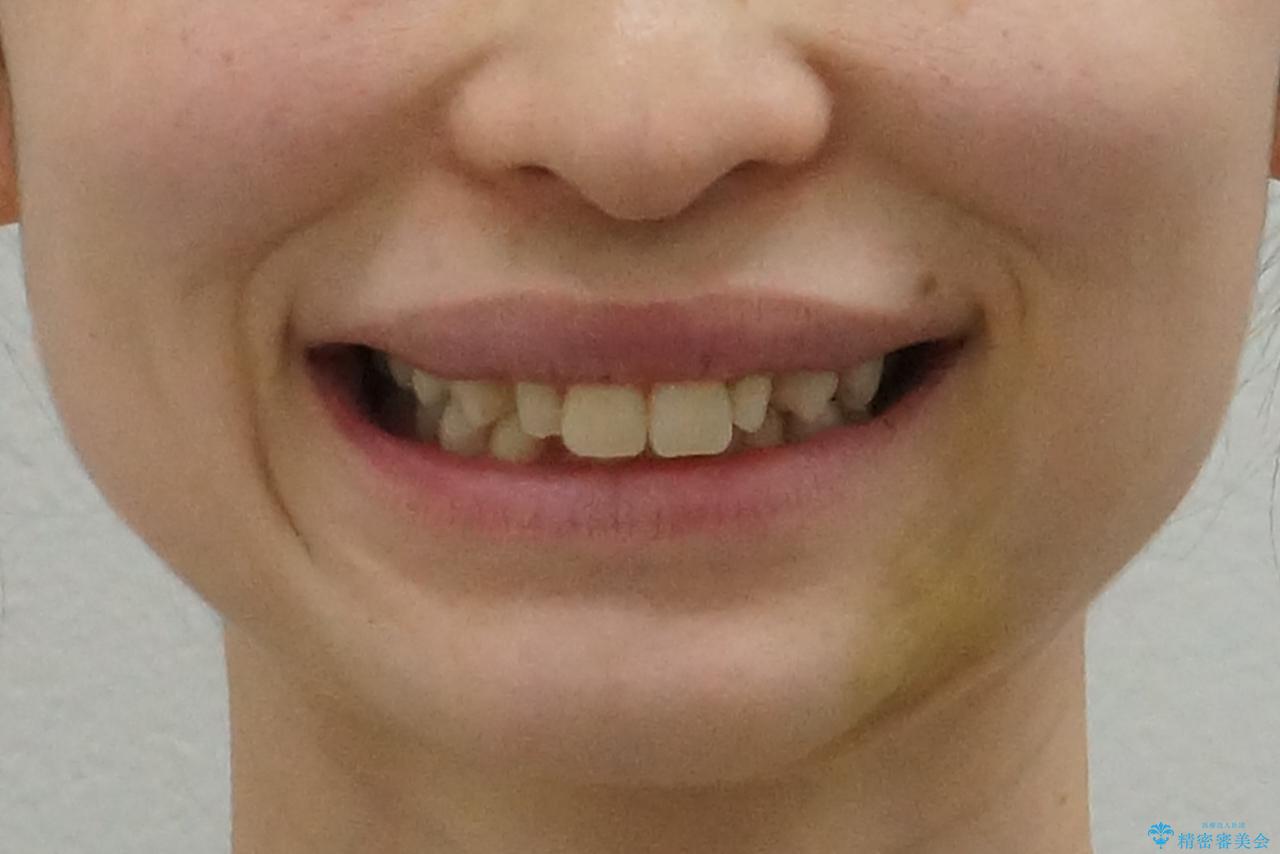 前歯を整えたい　小さい前歯がある　矯正・セラミック併用で美しく　インビザラインでも抜歯矯正できますの治療前（顔貌）