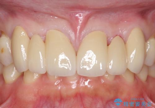 オールセラミッククラウン　部分矯正とセラミックによる前歯部の見た目の改善の治療後