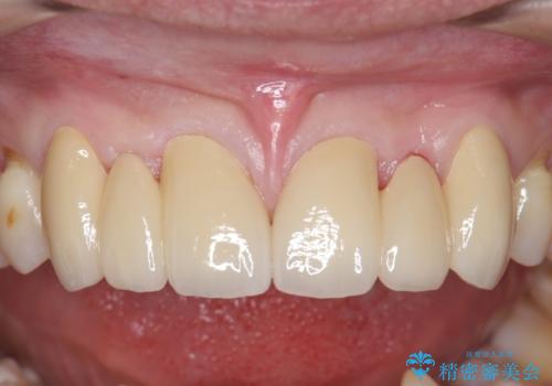 オールセラミッククラウン　部分矯正とセラミックによる前歯部の見た目の改善の治療後