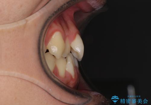 八重歯を治したい　目立たないワイヤー装置での抜歯矯正の治療前