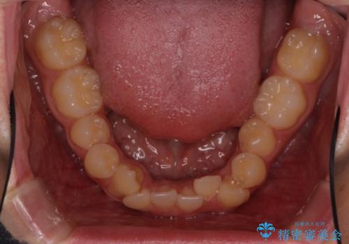 八重歯を治したい　目立たないワイヤー装置での抜歯矯正の治療前