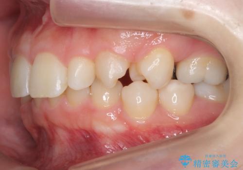 前歯を整えたい　小さい前歯がある　矯正・セラミック併用で美しく　インビザラインでも抜歯矯正できますの治療前