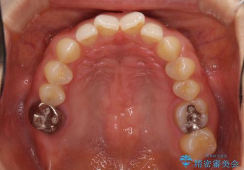 隙間だらけの歯列をきれいに　インビザライン矯正とセラミック補綴治療の治療前