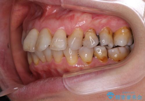 閉じにくい口元を改善したい　ワイヤー装置での抜歯矯正の治療前