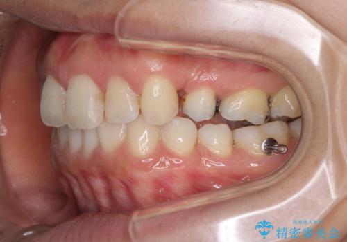 前歯の突出を軽減　インビザラインによる抜歯矯正の治療中