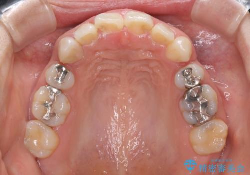 前歯の突出を軽減　インビザラインによる抜歯矯正の治療中