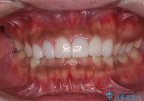 欠けてしまった前歯のセラミック　同じ色合いで再製作の治療前