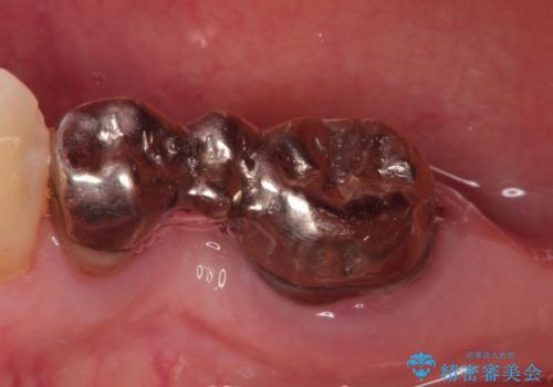 奥歯がなくなり咬めない　インプラント治療による咬み合わせの回復の治療前