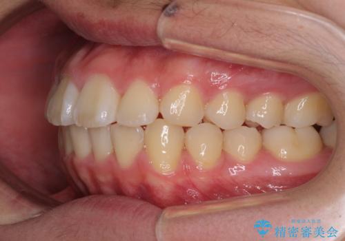 前歯のデコボコを短期間で治療　目立たないワイヤー矯正の治療後