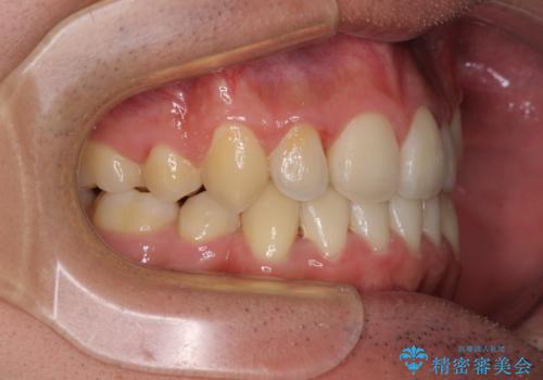 八重歯を治したい　目立たないワイヤー装置での抜歯矯正の治療後
