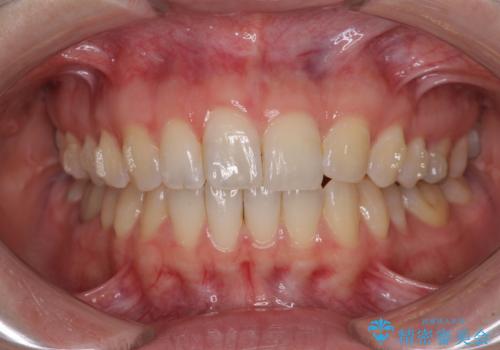 気になる上の歯を改善　インビザライン矯正の治療中