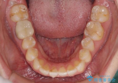 気になる上の歯を改善　インビザライン矯正の治療中